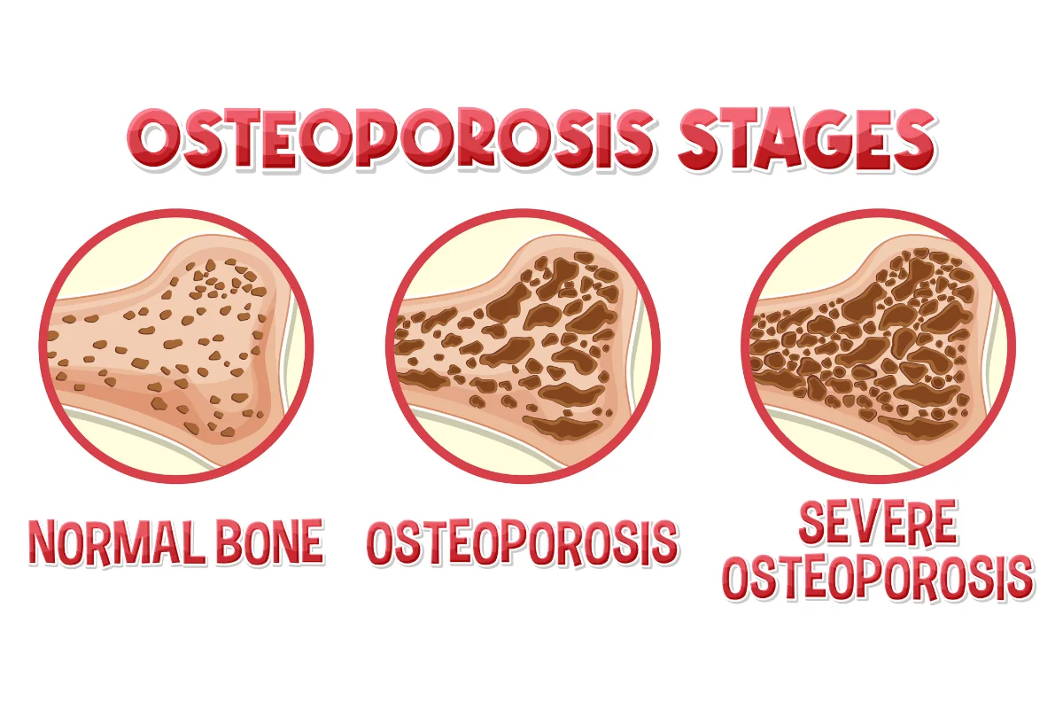 osteodensitometria REMS