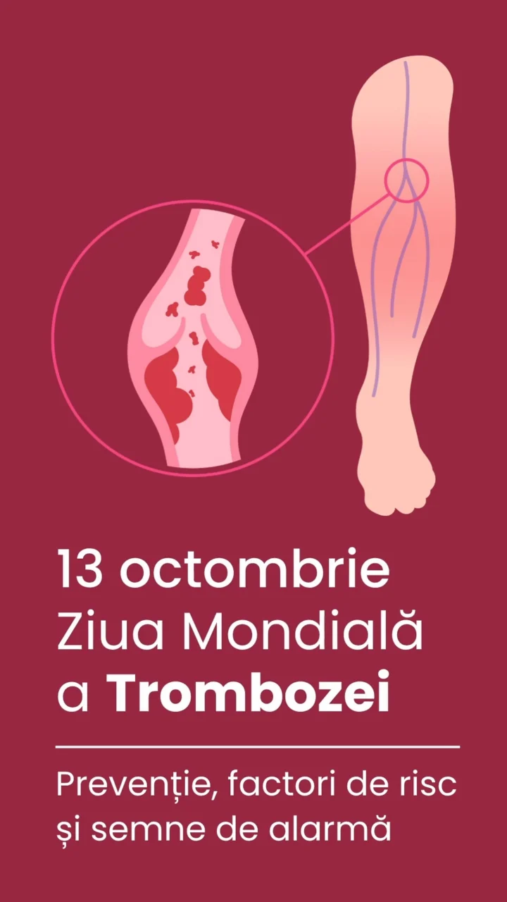 🩸 13 octombrie – Ziua Mondială a Trombozei! 🩸 Tromboza apare atunci…