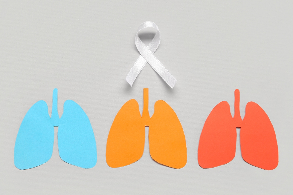 Cancer pulmonar recunoastere diagnostic si optiuni de tratament